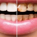 What is the Difference Between Preventive and Restorative Dental Treatments?