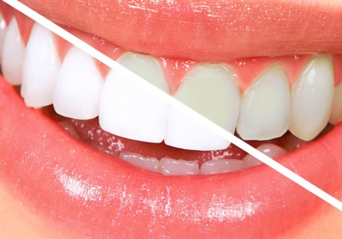 What is the Difference Between NHS and Private Dental Treatments?